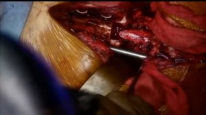 En Bloc Resection of T5 Giant Cell Tumor - Surgical Video