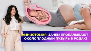 Как прокалывают околоплодный пузырь в родах💦? ЧТО ТАКОЕ АМНИОТОМИЯ