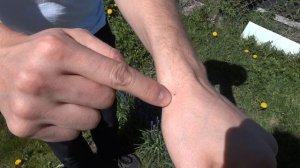 Лечение пчелами