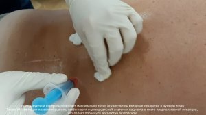 Лечение БОЛИ В СПИНЕ Back Pain Local Injections Остеохондроз Грыжа Диска