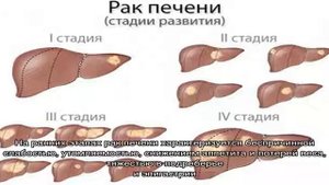 Рак печени