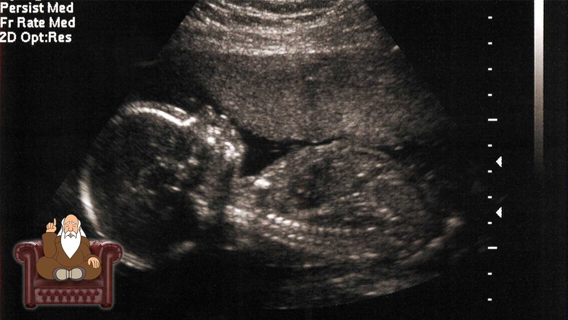 Мальчик 20 недель беременности. Задержка внутриутробного развития плода на УЗИ.