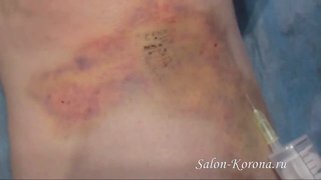 Удаление сосудов и новообразований смотреть онлайн