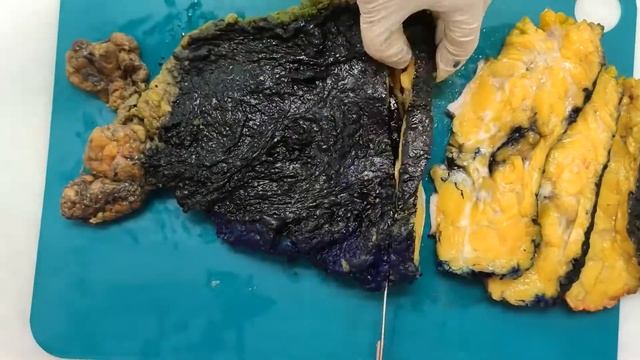 Радикальная мастэктомия после секторальной резекции