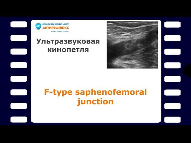 F-type saphenofemoral junction