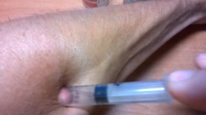 Как вытащить клеща