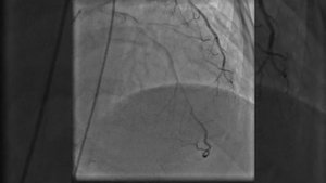 Коронарография после инфаркта