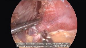 Лапароскопическая   спленэктомия БЕЗ КЛИПС И ДРЕНАЖЕЙ