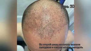 Пересадка волос. Два месяца (восемь недель)