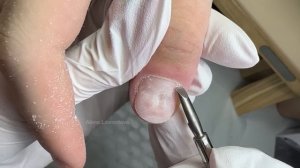 Как отрастает грызун? Грызет ногти что делать? Ковыряет ногти как исправить?