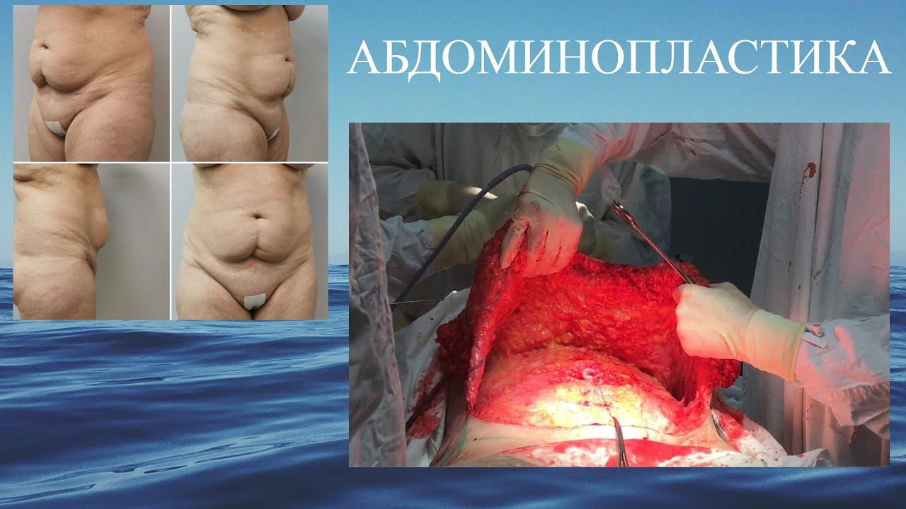 Абдоминопластика