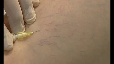 Склеротерапия