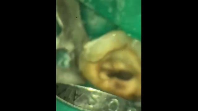 2021-04-28 Извлечение старого серебряного штифта смотреть онлайн