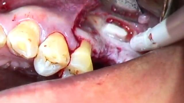 Lateral Window Sinus Augmentation: sequence of piezoelectric surgery tips смотреть онлайн
