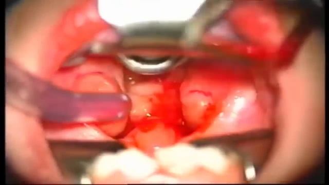 Аденотомия классическим методом под общим наркозом.mp4