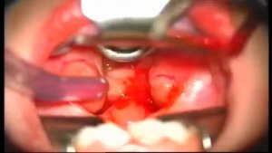 Аденотомия классическим методом под общим наркозом.mp4