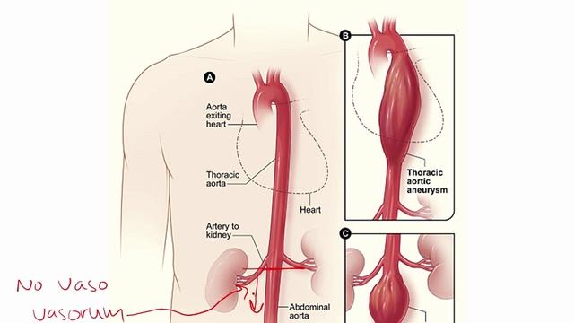 USMLE RX - 2.Кардиология - 3.Патология - 3.Аневризма аорты