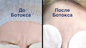 Ксеомин, ботокс, диспорт – удаление морщин  | botox blog
