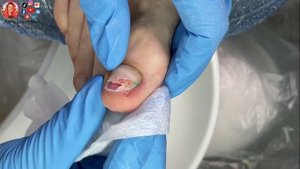 Пустота под ногтем ?⚡Травма ногтя и онихолизис