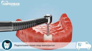 Съемный  протез на имплантатах. Этапы установки протеза с шаровидным креплением