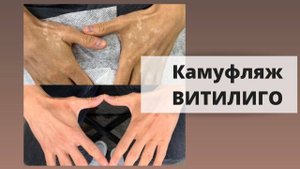 КАМУФЛЯЖ ВИТИЛИГО на веках и руках. Процесс проведения камуфляжа витилиго.