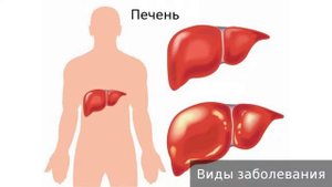 Гепаторенальный синдром. Как лечить гепаторенальный синдром.