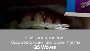 QUARTZ SPLINT WOVEN - шинирование подвижных зубов кварцевой шинирующей лентой