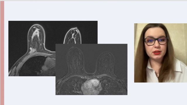 Вебинар "МРТ молочных желез - Мозговой штурм" смотреть онлайн