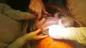 Кесарево сечение пузыре