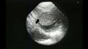 Видеолекция клиники Мэйо  Кардиомиопатии 7 я лекция