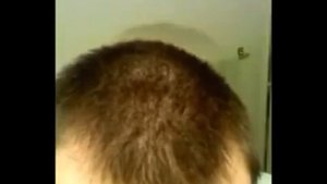 Миноксидил для Волос результат До После