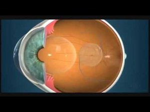 Линзы. Мультифокальные линзы