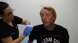 Justin's Inspiring Transformation - Face Tattoo Removal - 11th Treatment
