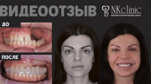 Протезирование и восстановление верхней челюсти