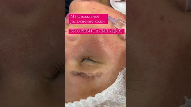 Максимальное увлажнение лица- Биоревитализация смотреть онлайн