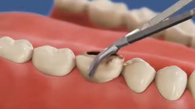 Атрофия кости в области 1 зуба смотреть онлайн