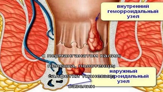 Как быстро проходит геморроидальный узел Ванночки и клизмы с марганцовкой при геморрое - смотреть видео онлайн от "Секрет