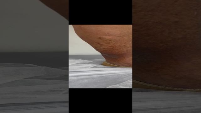 Рецидив варикоза после открытой операции Ч.2. Тазовый варикоз. Флеболог Москва. Флеболог. Хирург смотреть онлайн