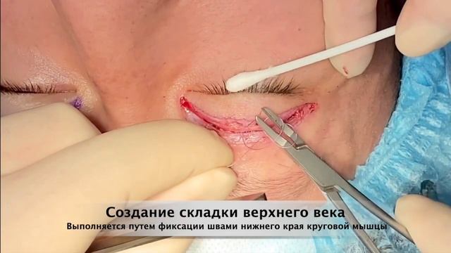 Верхняя Блефаропластика. Европеизация азиатских век (Сингапури).