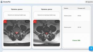 Расчет стеноза позвоночного канала поясничного отдела с помощью искусственного интеллекта DoctorPal