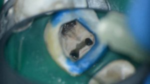 Извлечение инструмента с помощью петли