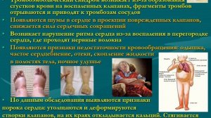 2 курс ФКП. Лекция на тему: "Ревматизм. Острая ревматическая лихорадка"