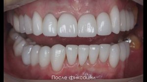 Керамические виниры. Имплантация зубов. Коронки из диоксида циркония и имакс (Emax)