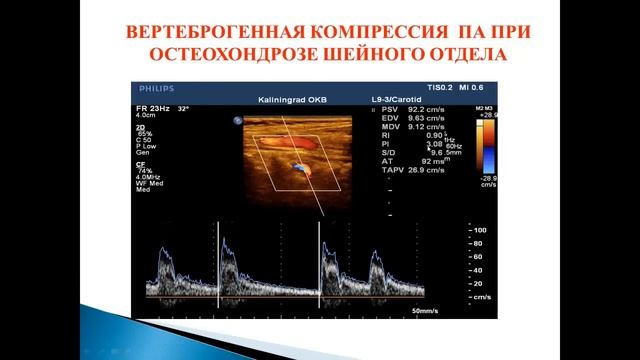 Ультразвуковая диагностика патологии вертебро-базилярной системы