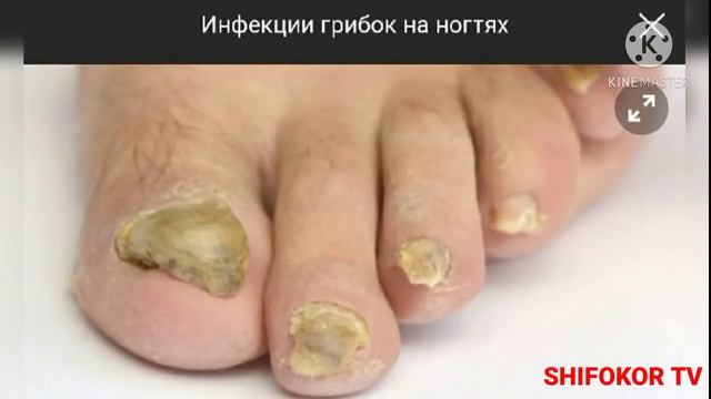 #REVMATIZM #NECHA #YOSHDA #BOSHLANADI #VARIKOZCHI #РЕВМОТИЗМ #НЕЧА #ЙОШДА #БОШЛАНАДИ #ВАРИКОЗЧИ...