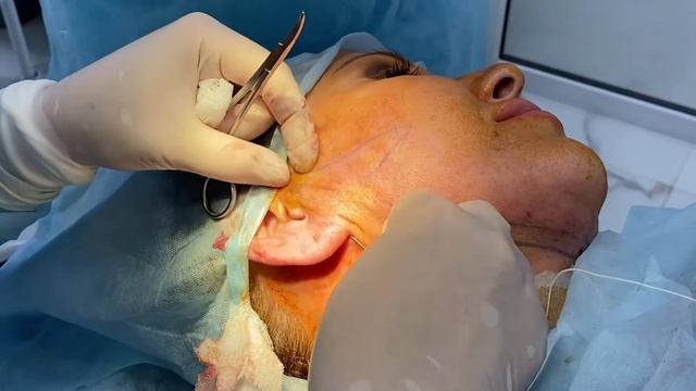 Превью онлайн-курса Ольги Газиуллиной - Лифтинг нитью Elasticum с английскими булавками смотреть онлайн