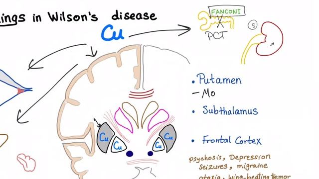 Wilson disease смотреть онлайн