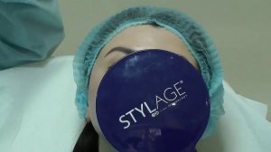 Коррекция небольшой носогубной складки филлерами Stylage.