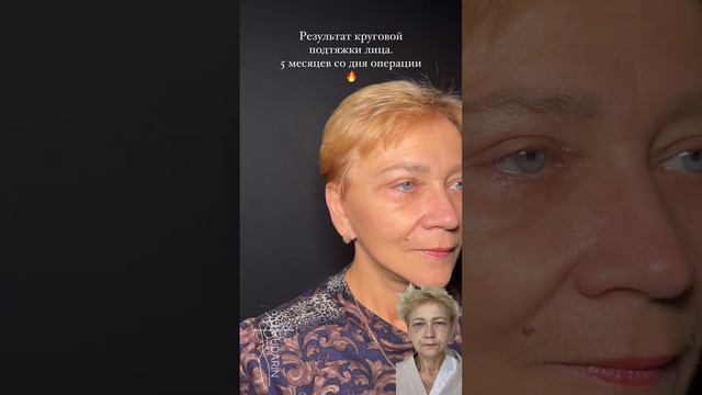 Комплексное омоложение лица от пластического хирурга Бударина Михаила Сергеевича🔥