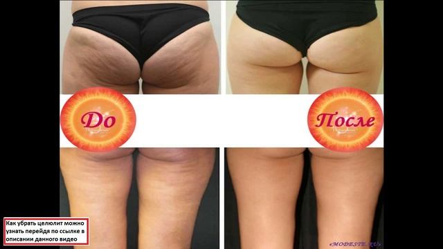 целюлит, как сделать кожу гладкой смотреть онлайн